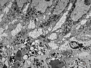 Whipple disease Whipple disease
